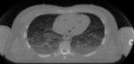 CT image of lungs and heart